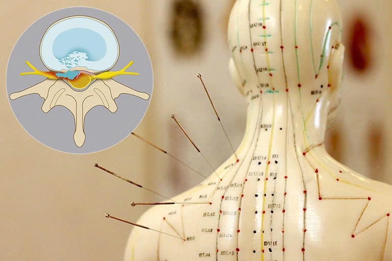 Phương pháp Châm Cứu trong Đông Y