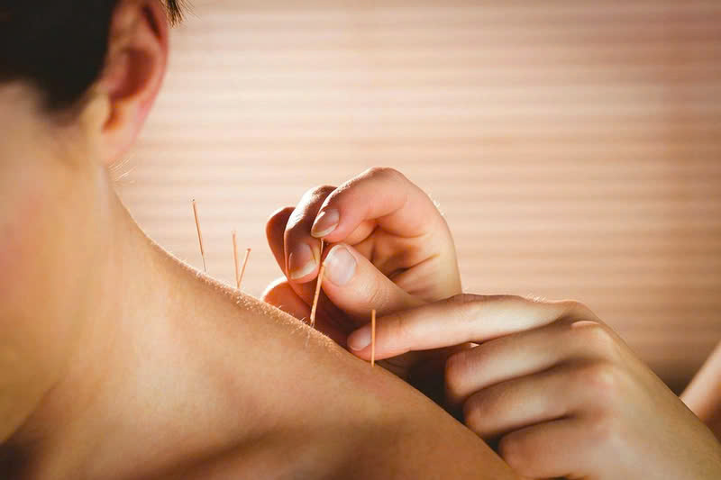 Đông y trị bệnh mất ngủ kinh niên bằng phương pháp châm cứu