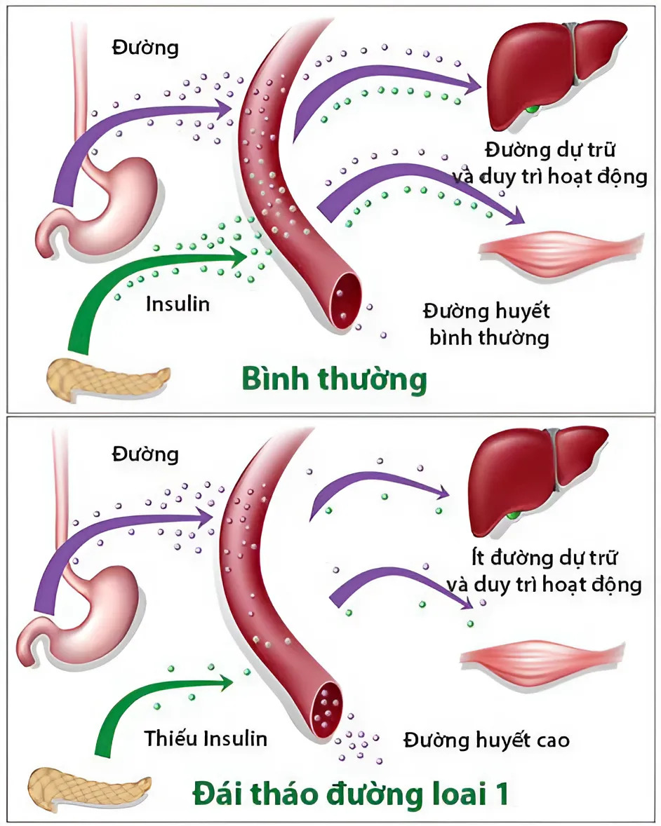 Bệnh Tiểu Đường là gì? Dấu hiệu nhận biết? Cách điều trị tốt nhất?