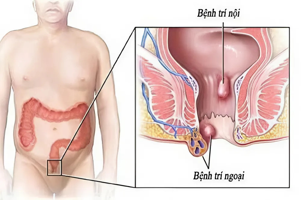 Điều Trị trĩ nội – trĩ ngoại