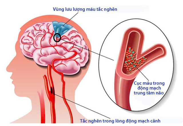 Điều Trị Tai biến mạch máu não 