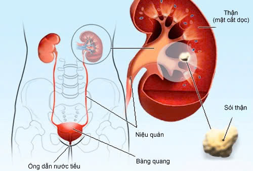 Điều Trị Sỏi thận, suy thận